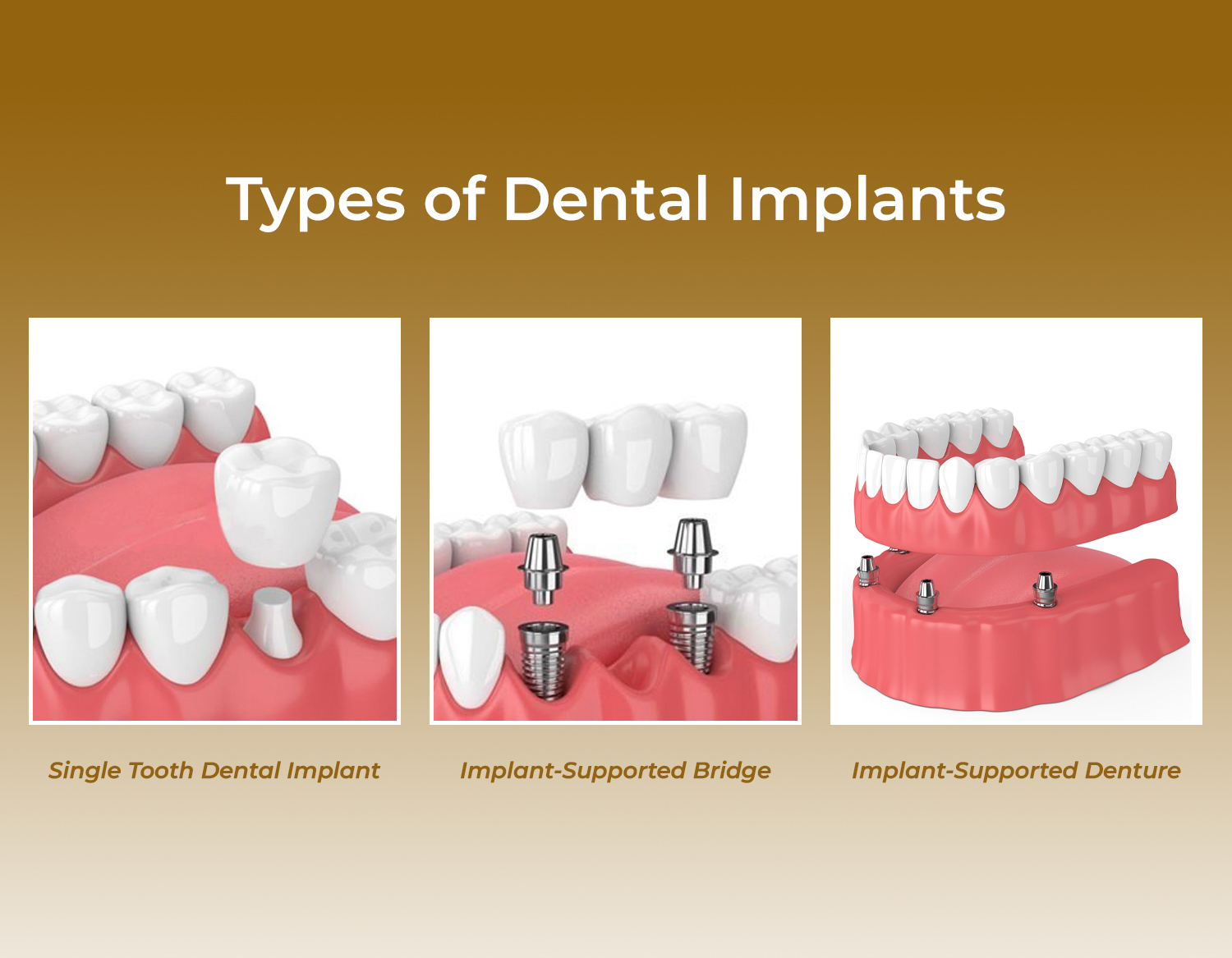 types-of-dental-implants