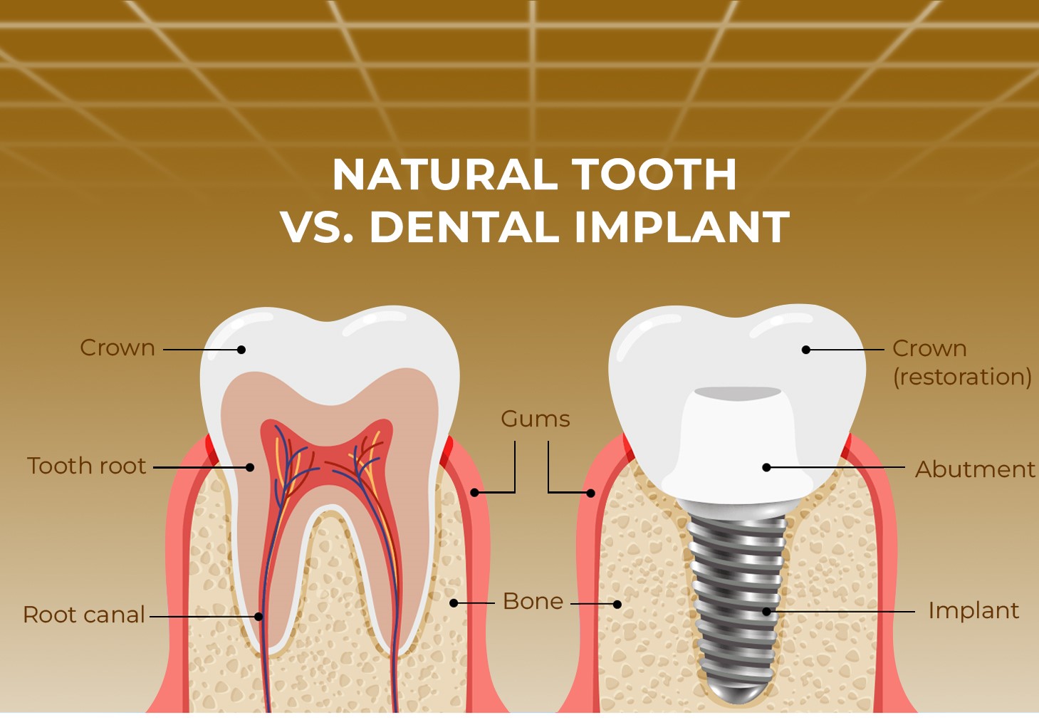 dental-implants-structure