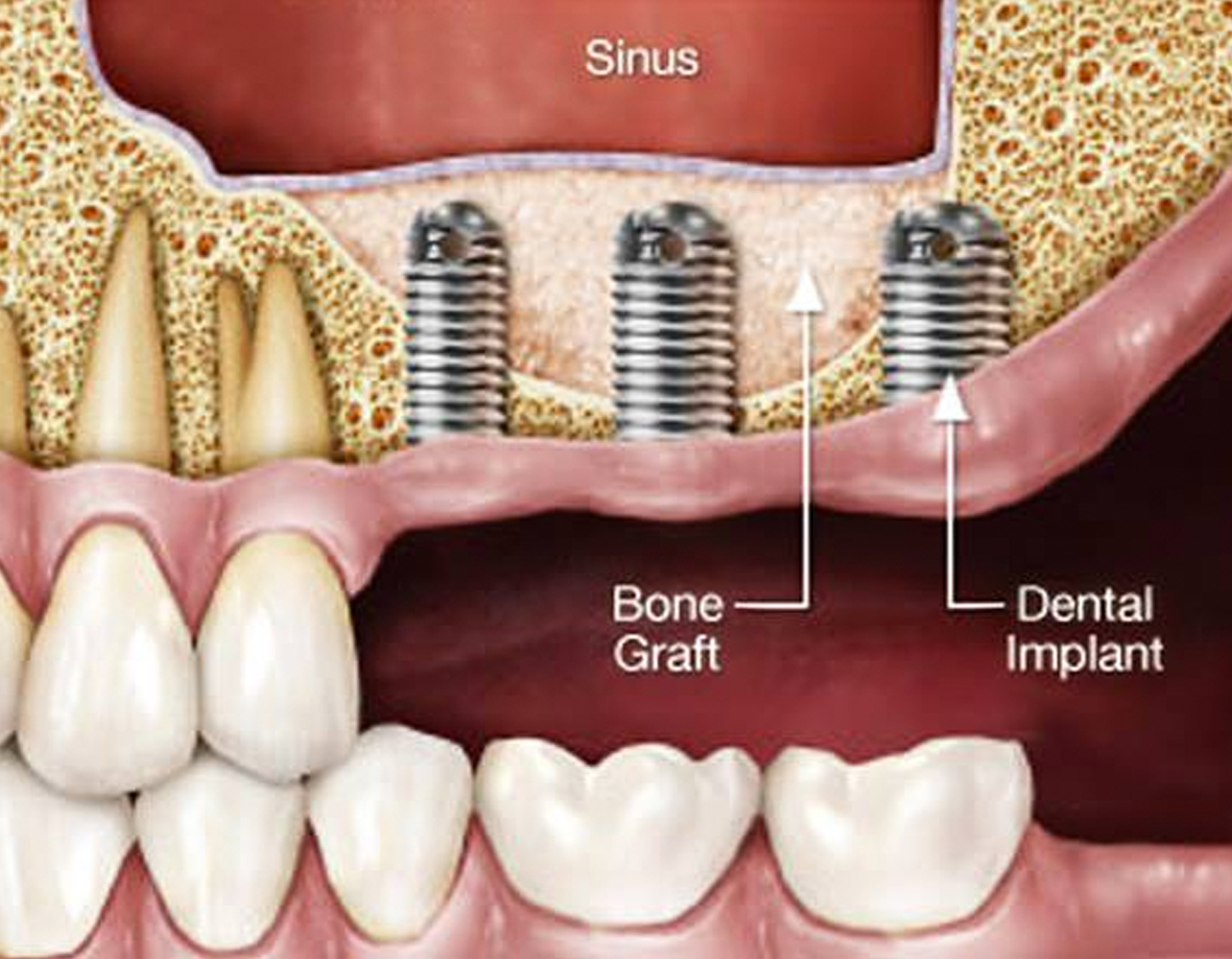 dental-bone-graft-cost