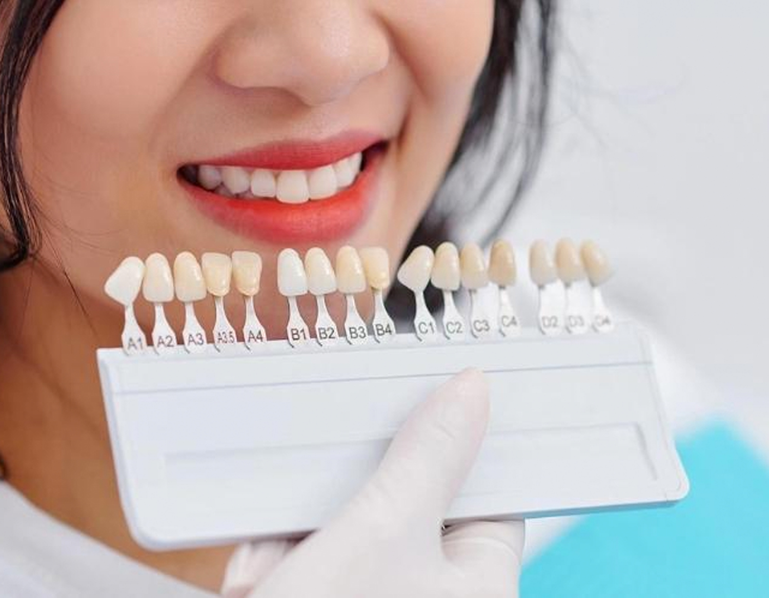 types-of-dental-veneers