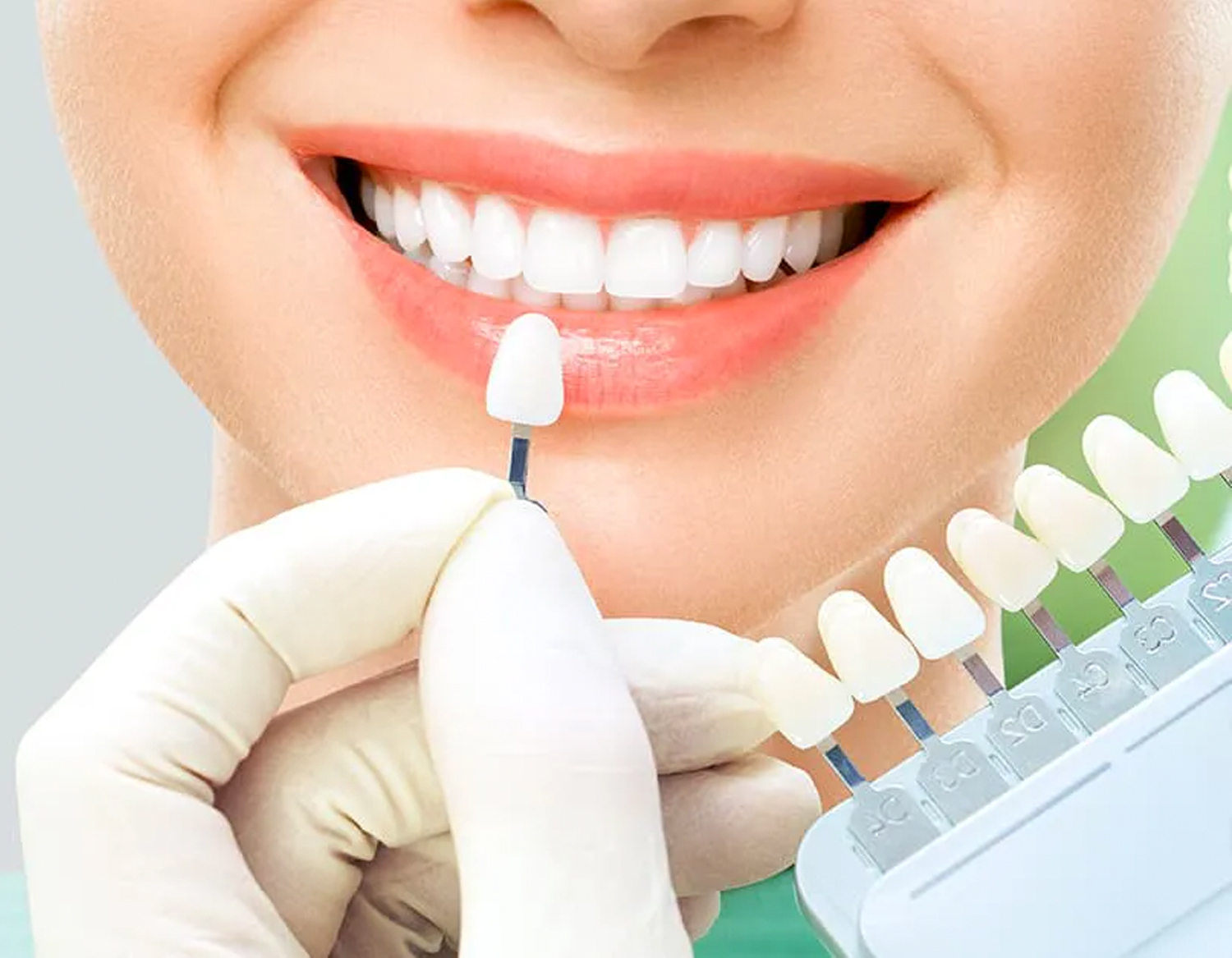 do-you-know-exactly-about-dental-veneers