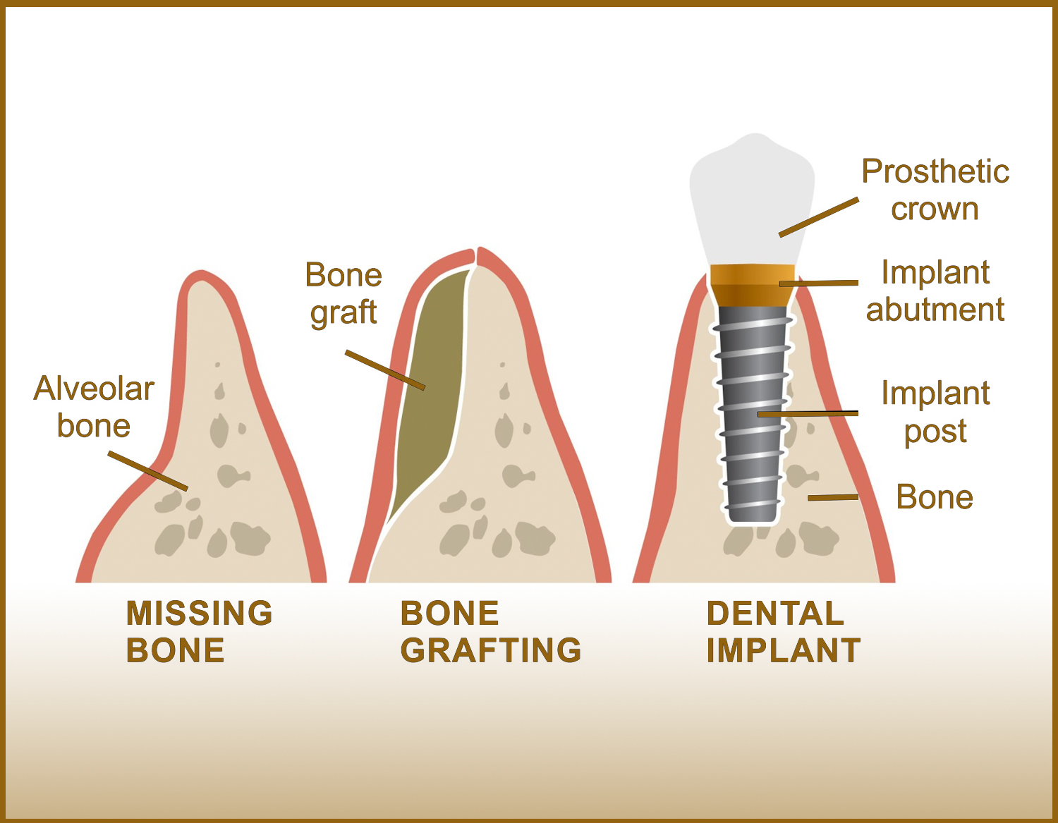 dental-bone-graft-structure