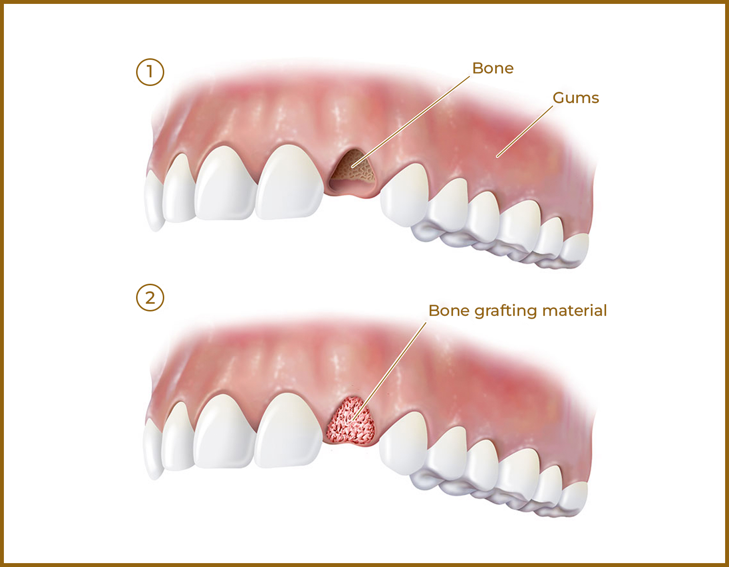 dental-bone-graft-material