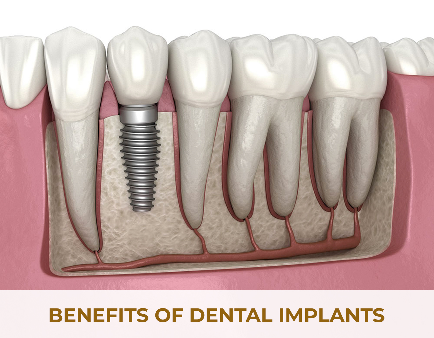 benefits-of-dental-implants-restoration
