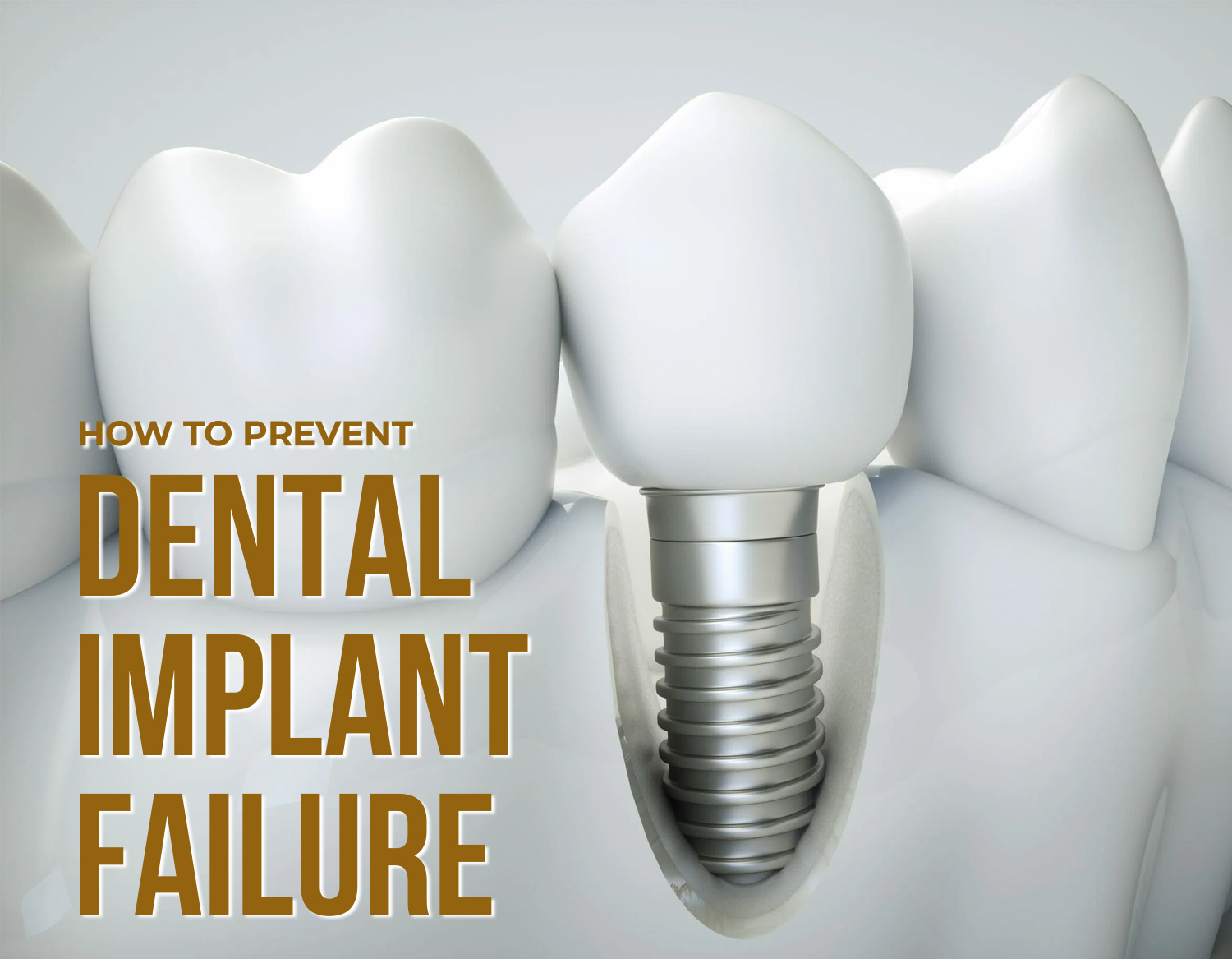 factors-impacting-dental-implants-restoration