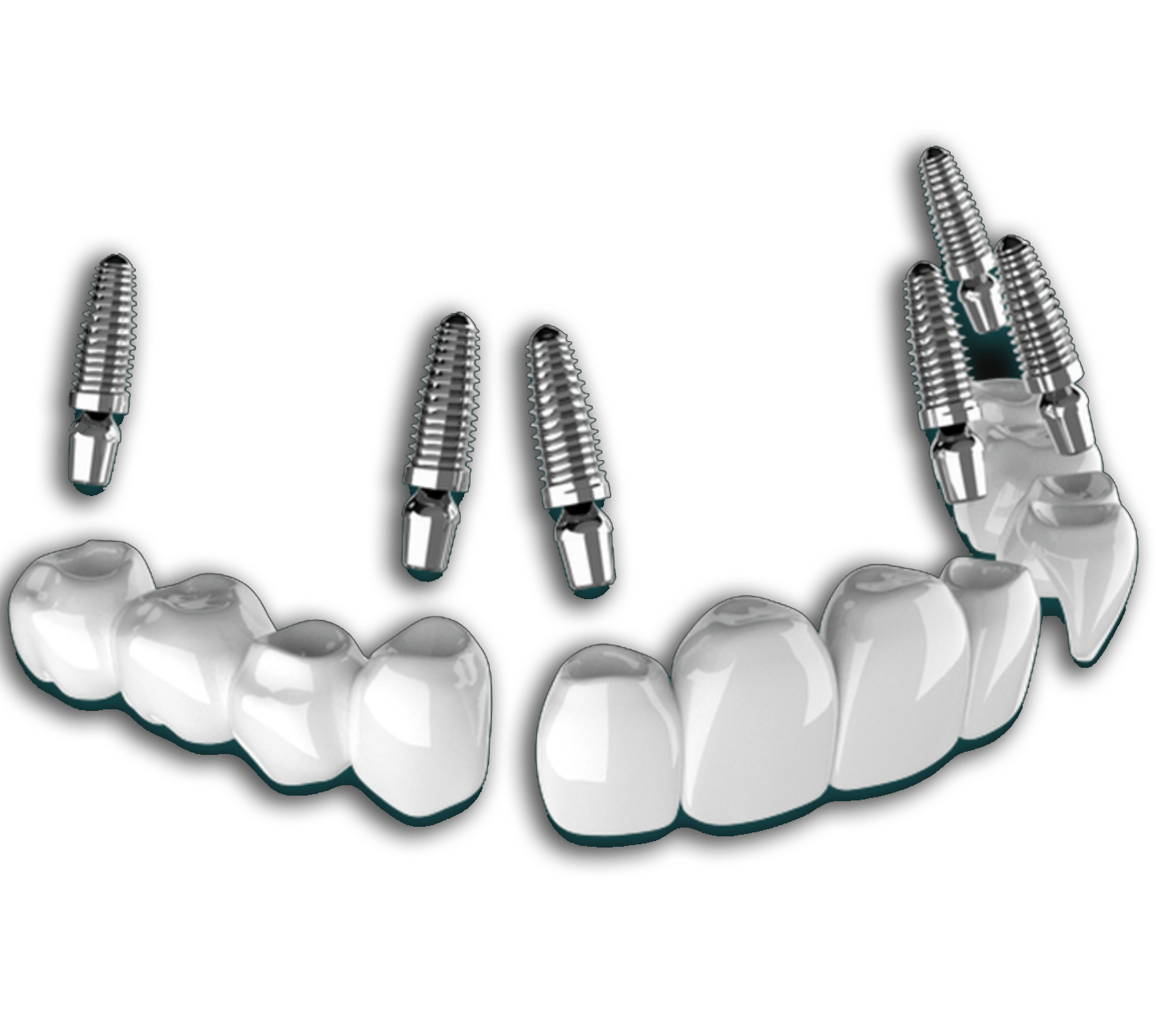 all-on-6-dental-implants