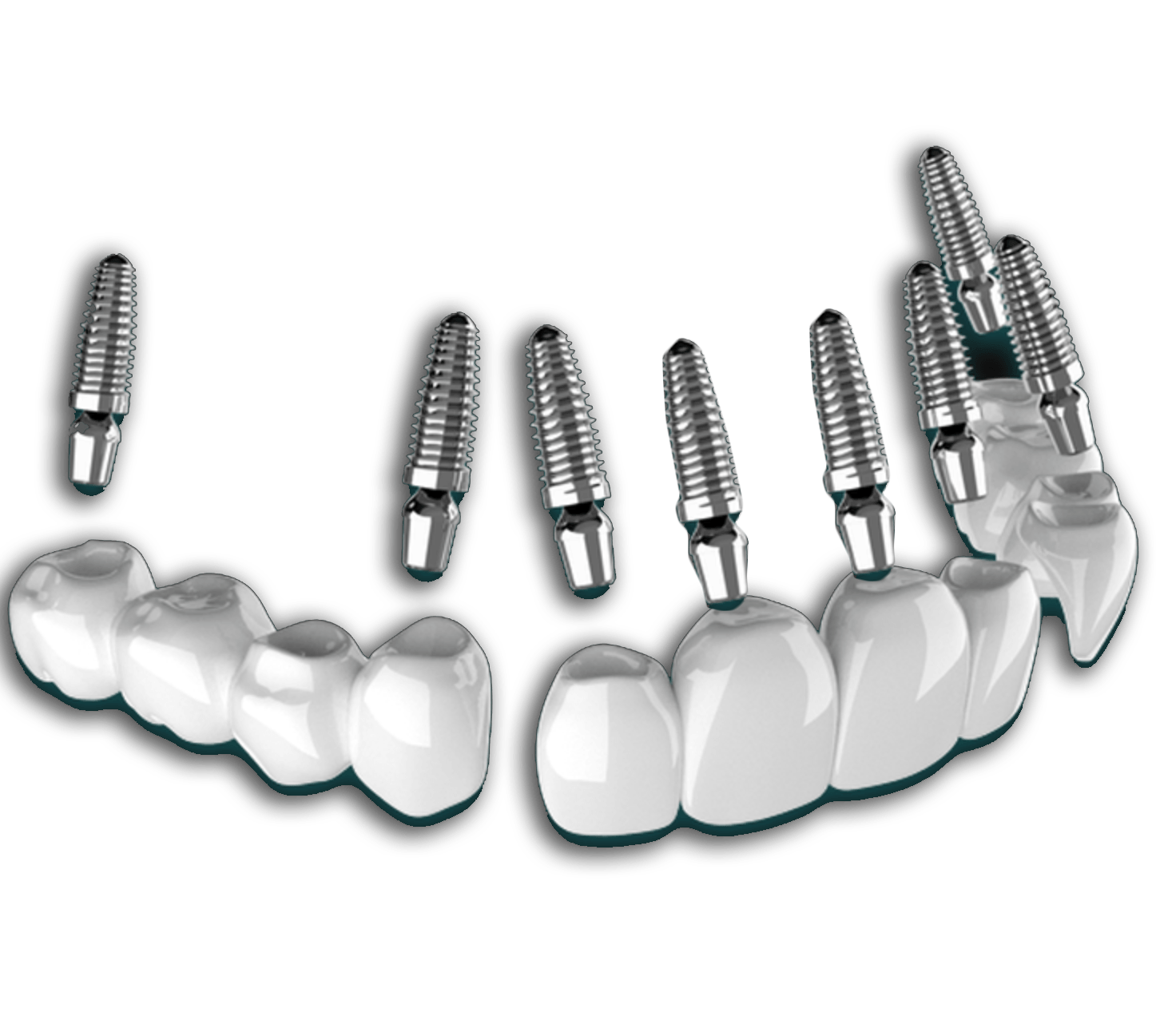 all-on-8-dental-implants