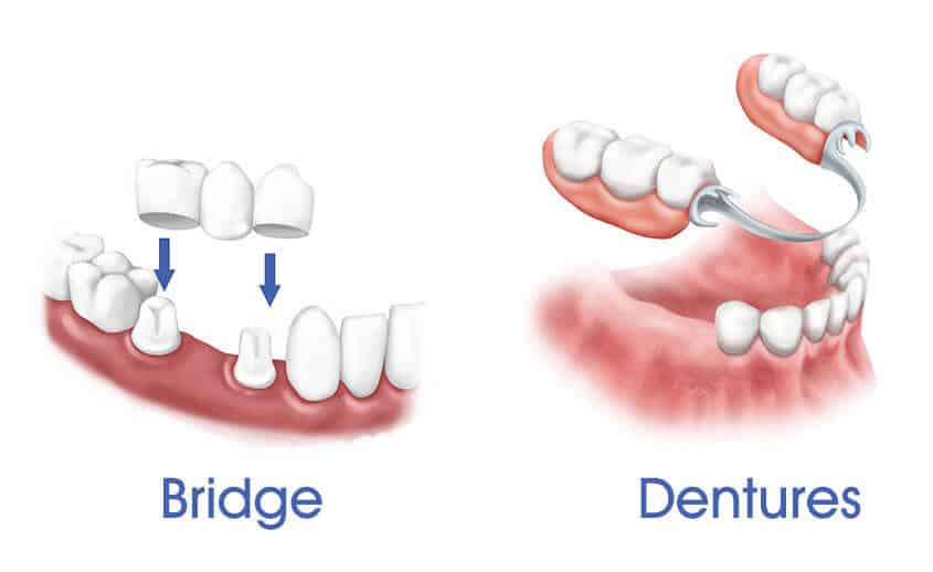 bridge-vs-dentures