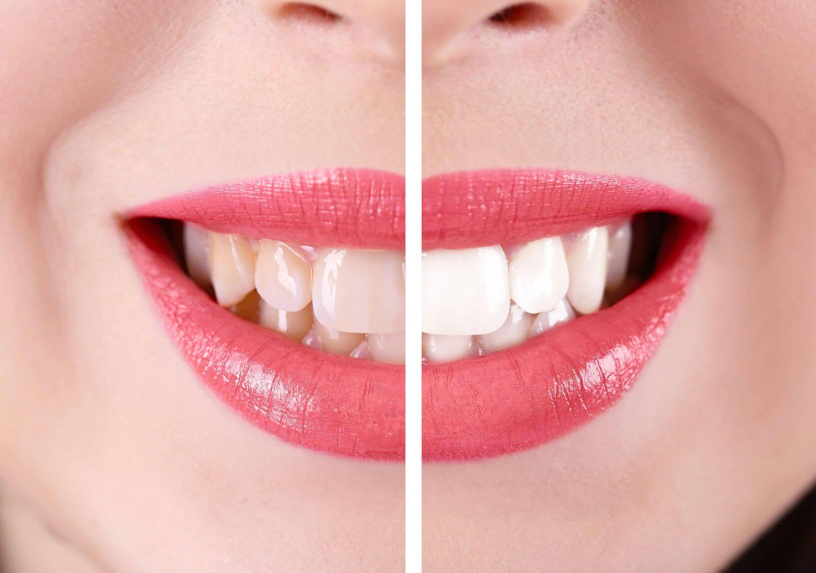 types-of-dental-veneers-composite-veneers-vs-porcelain-veneers