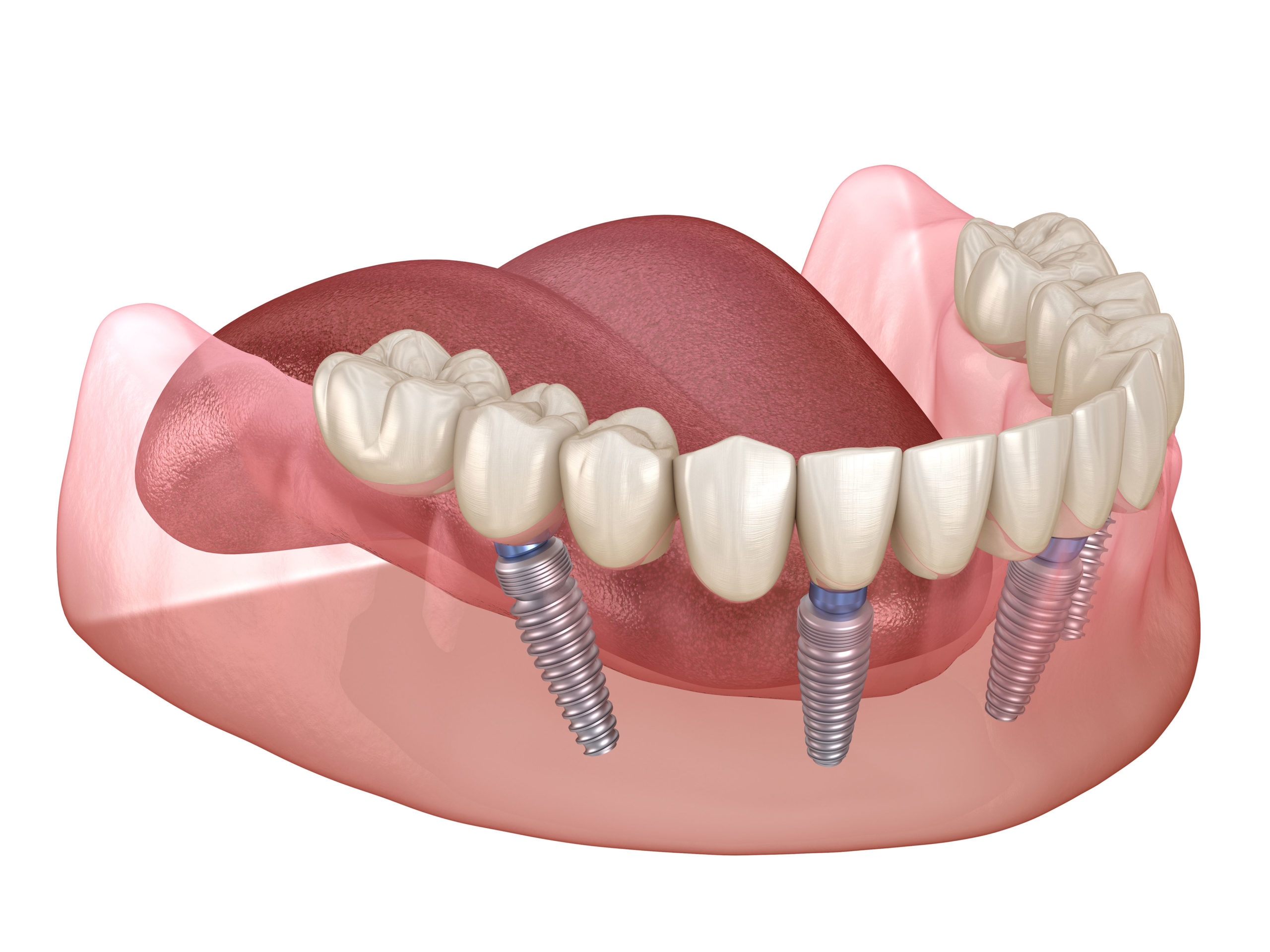 full-mouth-dental-implants-cost