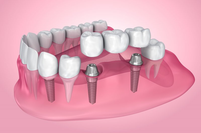 multiple-dental-implants-cost