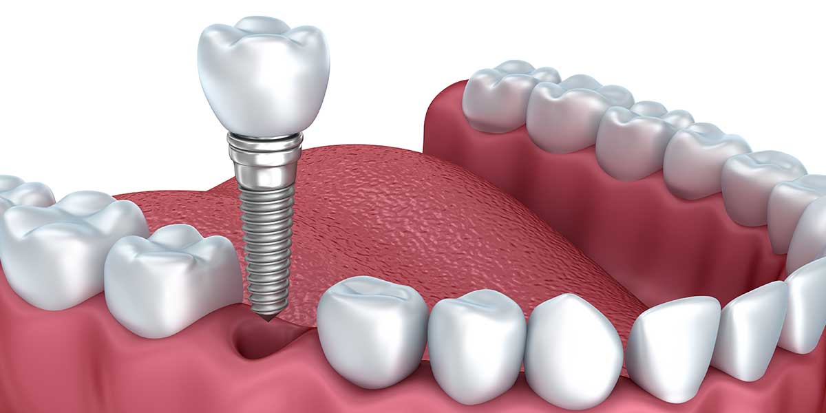 single-dental-implants-cost