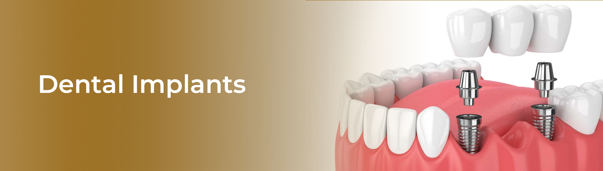 dental-implants-fee