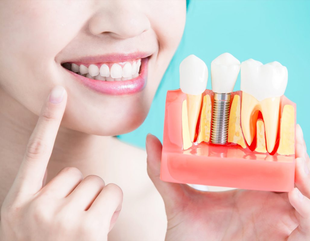 do-you-know-exactly-about-dental-implants