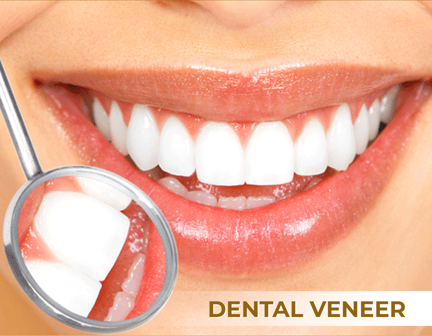 how-much-do-dental-veneers-cost-in-vietnam-2022