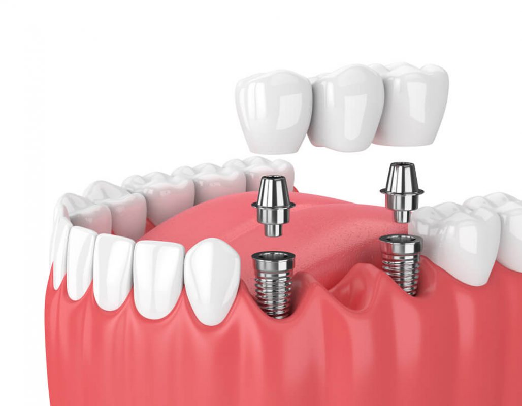 everything-about-dental-implant-restoration