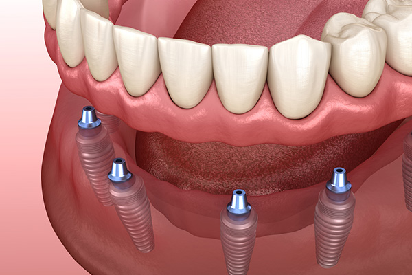 all-on-4-all-on-6-all-on-8-dental-implants-differences