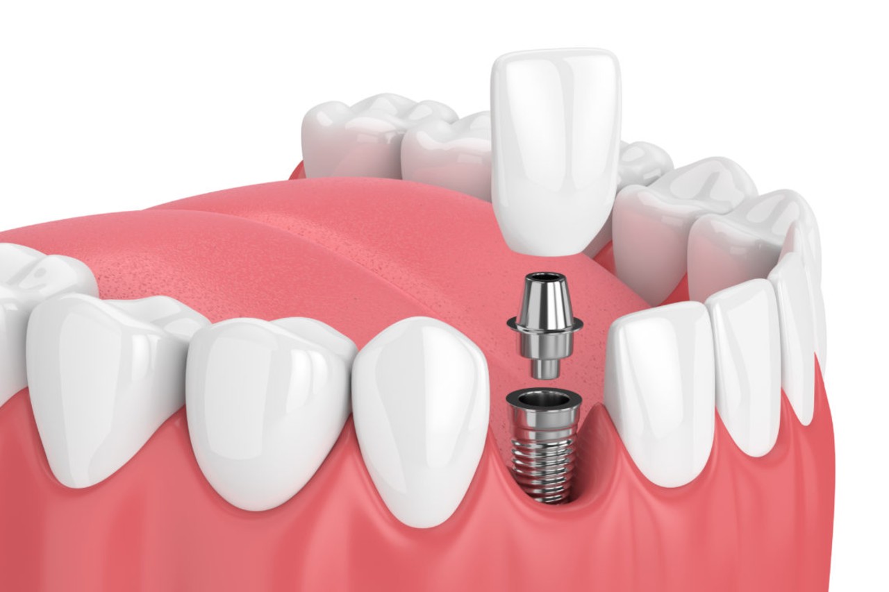 how-much-do-dental-implants-cost