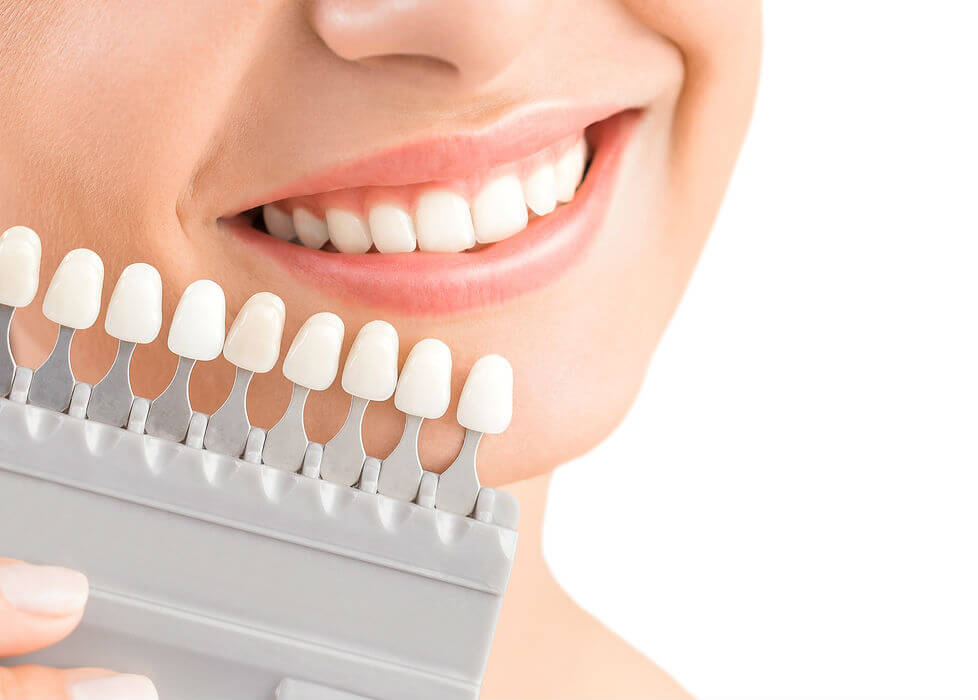 types-of-dental-veneers-right-for-you